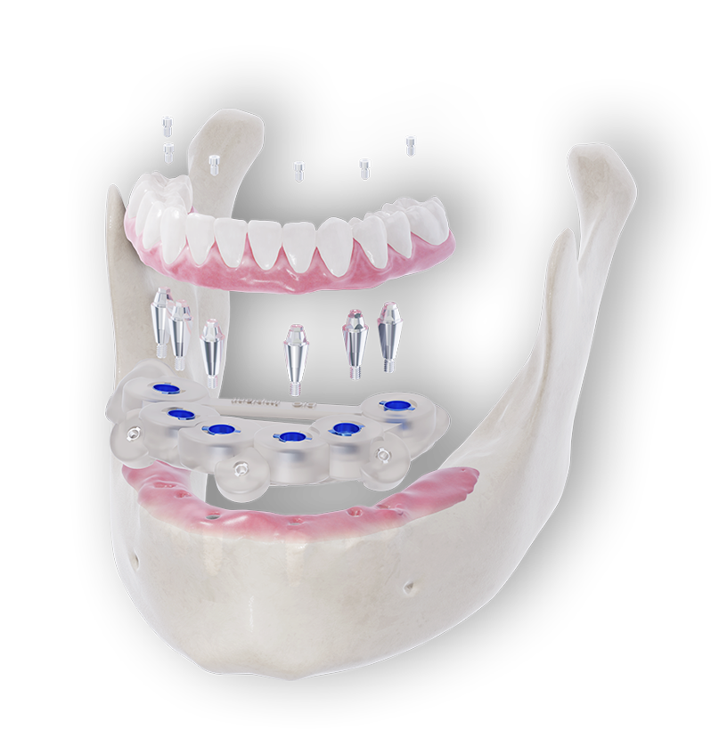 DIOnavi.Full Arch|DIOデジタル株式会社|インプラント・歯科医療用各種機器・材料